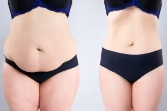 Tummy Tuck Procedure