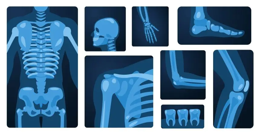 Bone Health and Diabetes: What You Need To Know