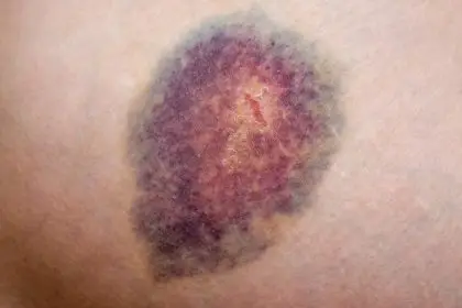 Does diabetes make you bruise more easily?