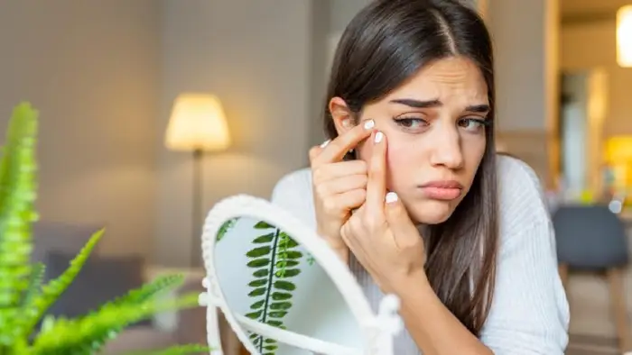 Benzoyl peroxide for acne: Is it effective for treating acne and blackheads?