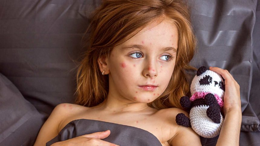 Measles outbreak in the US: Dos and Dos for people affected by this epidemic