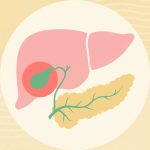 What Is Acalculous Cholecystitis?
