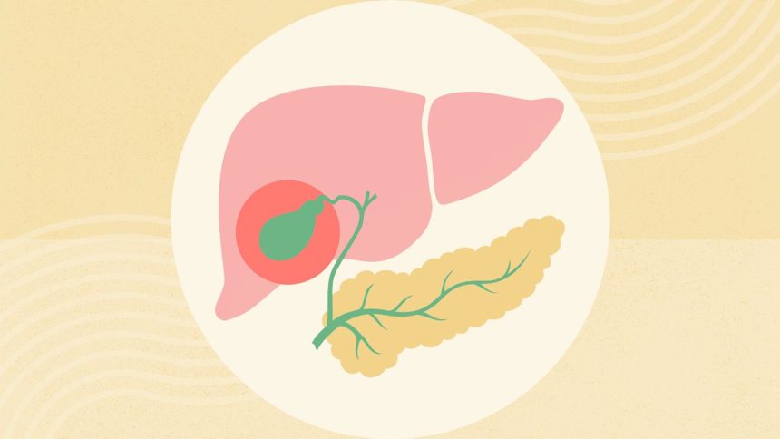 What Is Acalculous Cholecystitis?