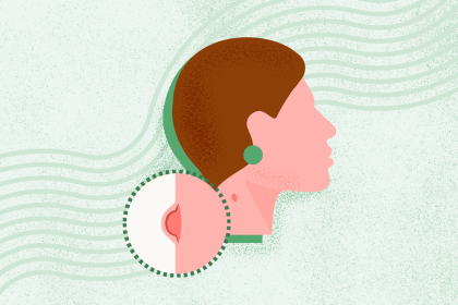 What Is Acne?
