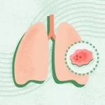 What Is Lung Cancer?