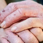 What Is Dyshidrotic Eczema?