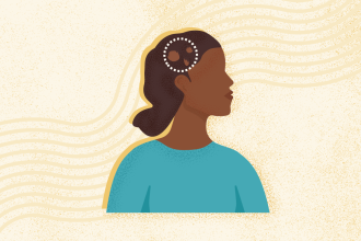 What Is Alopecia Areata? Symptoms, Causes, Diagnosis, and Treatment