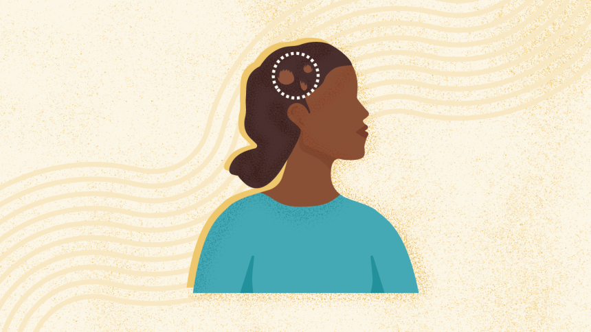 What Is Alopecia Areata? Symptoms, Causes, Diagnosis, and Treatment