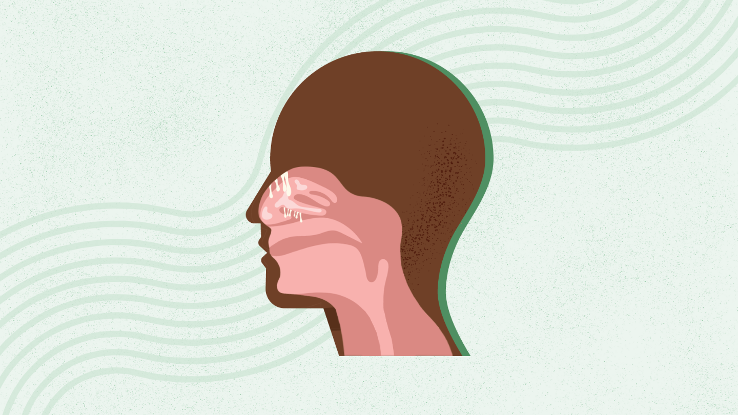 What Are Nasal Polyps? Symptoms, Causes, Diagnosis, Treatment, and Prevention