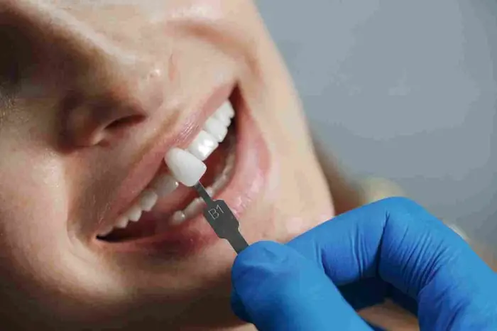 Veneer Makeovers in London