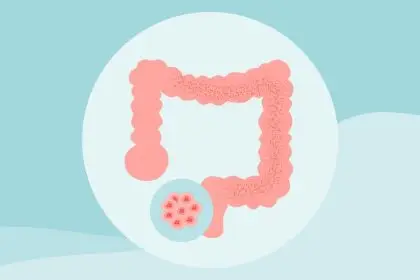 8 Myths About Colon Cancer Debunked
