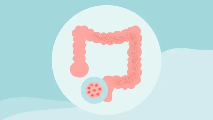 8 Myths About Colon Cancer Debunked