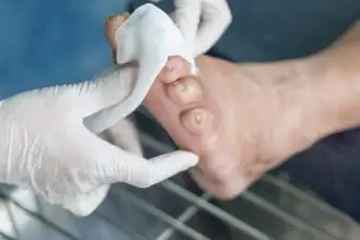 Armored feet of diabetes: Causes, diagnosis, treatment
