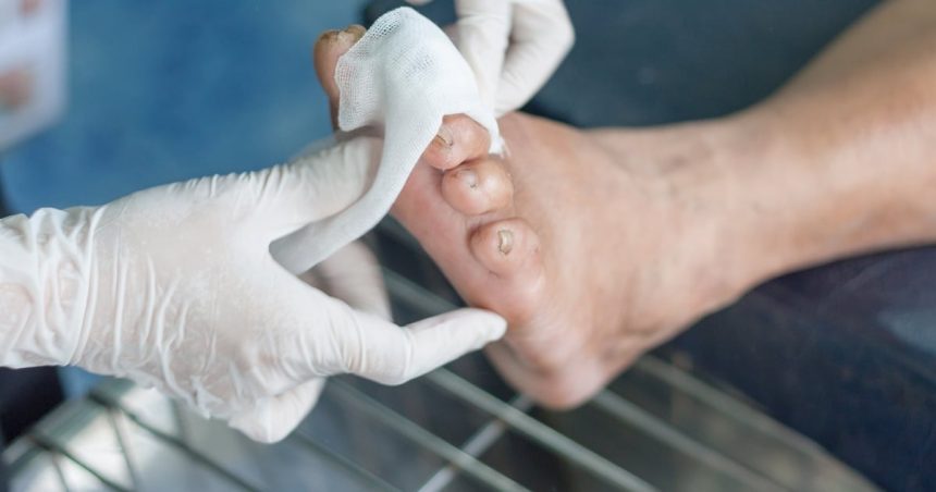 Armored feet of diabetes: Causes, diagnosis, treatment