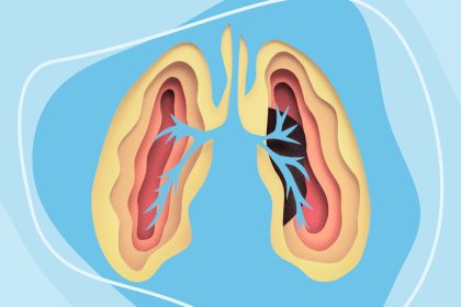7 Myths About Lung Cancer