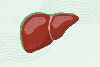 What Is Metabolic Dysfunction–Associated Steatohepatitis (MASH)?