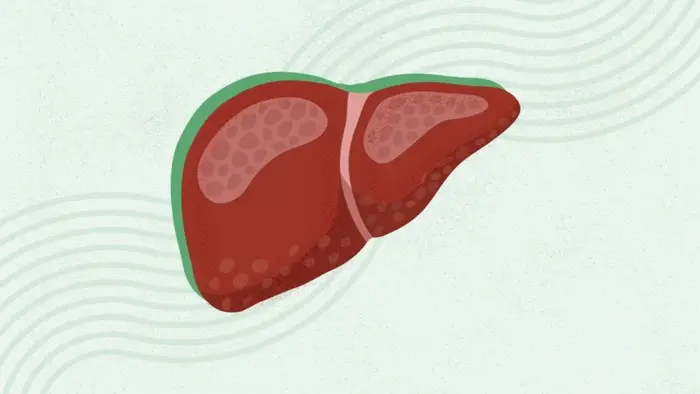 What Is Metabolic Dysfunction–Associated Steatohepatitis (MASH)?